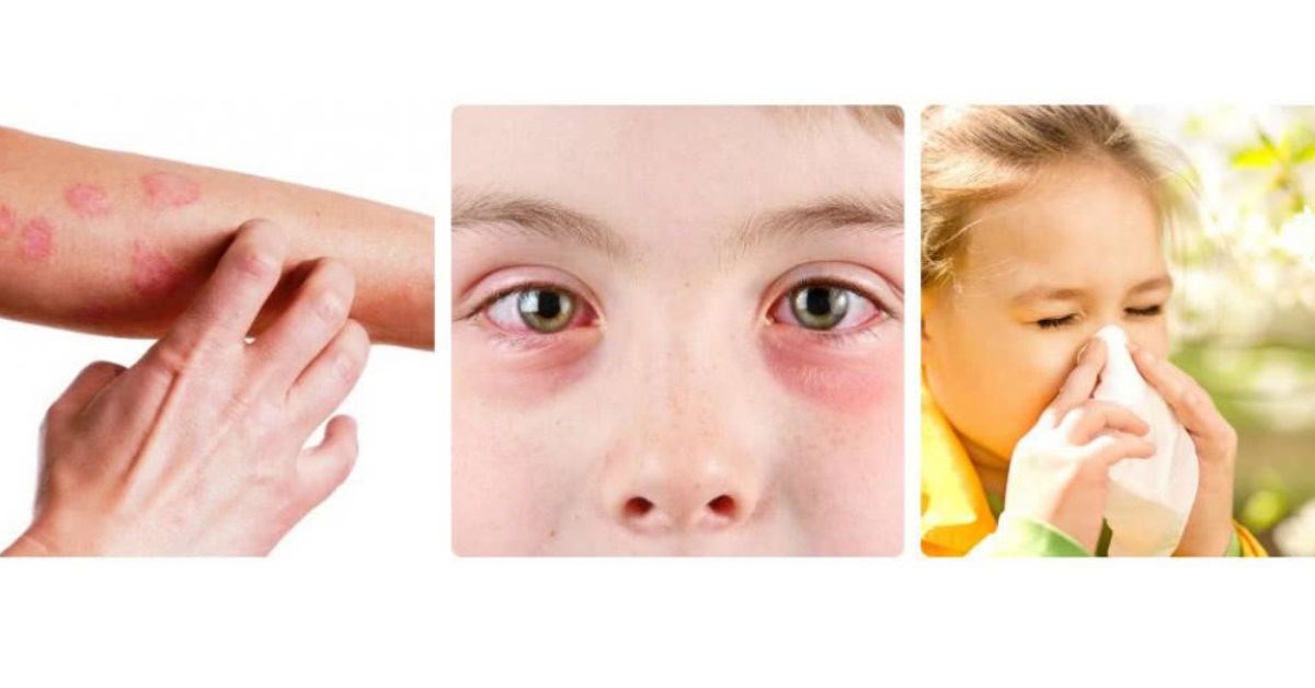 Какая самая редкая аллергия в мире?